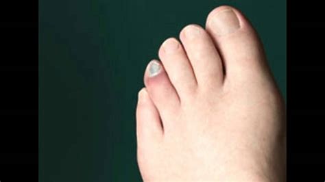 Understanding the Common Triggers for Toe Swelling in Reality