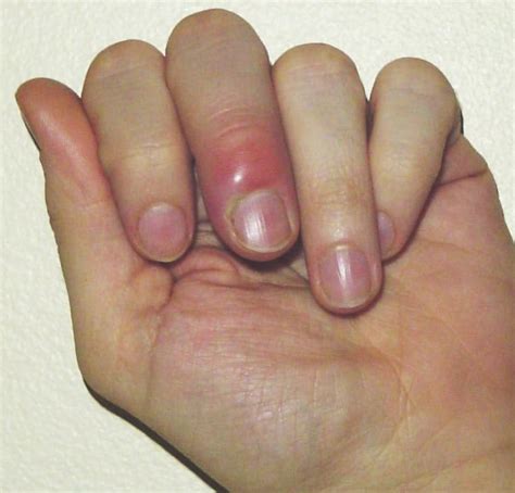 Understanding the Impact of Hand Infections on Daily Life