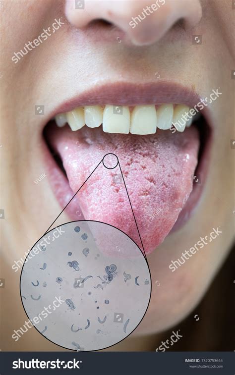 Understanding the Origins of Tongue Infections