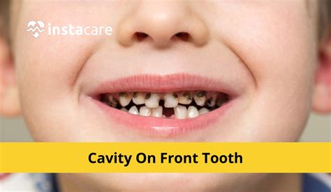 Understanding the Significance of Indentation Among Front Teeth