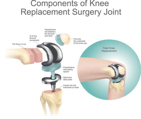 Unraveling the Significance Behind Dreams Involving Surgical Procedures on the Knee