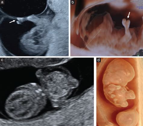 Unveiling an Unfortunate Discovery: The Consequences of Detecting an Abnormality during an Ultrasound Examination