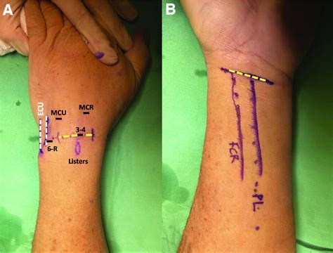 Unveiling the Subliminal Factors that Shape Dreams Involving Wrist Incisions