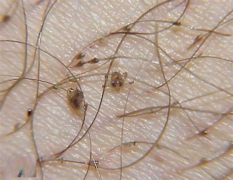 What are pubic lice?