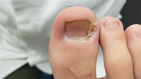 When to Seek Professional Help for Overgrown Toenails