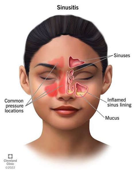 When to Seek Professional Help for Recurring Nasal Discomfort Dreams