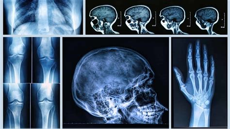 X-Rays in Medicine: Revolutionizing Diagnosis and Treatment